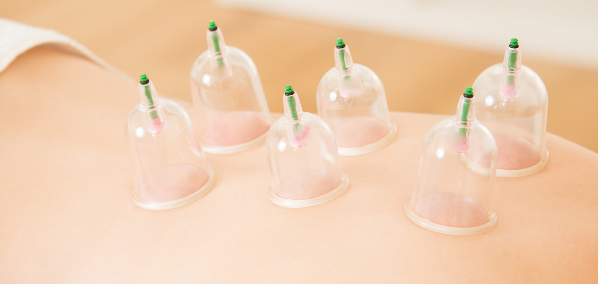 Cupping Cupping N. Lurie, LAc, DAOM